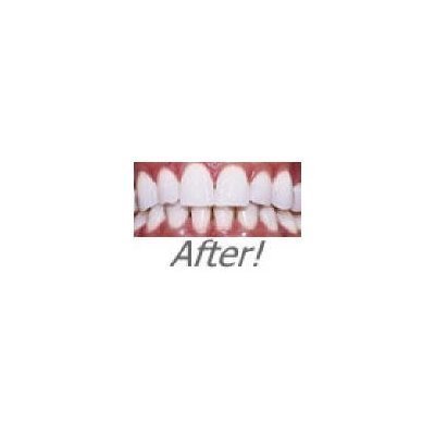 Instant bijeli osmijeh optimizirano 20cc 36% karbamid peroksid zubi za izbjeljivanje gel stisnutih s 2 gela za remineralizaciju s nijansom-