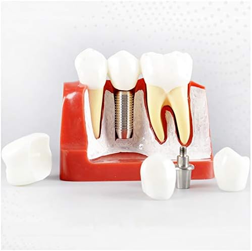 KH66ZKY Demonstracijski model zuba zubnih implantata - zubni model - Analiza implantata Model Crown Bridge Demonstracijski model zuba